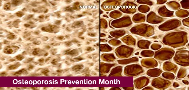 No image found 5743_Osteoporosis_Prevention_MonthE.webp