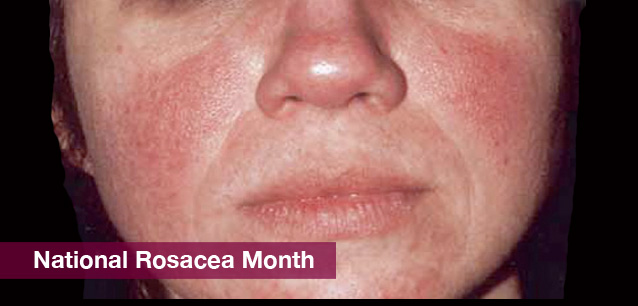 No image found 6233_Rosacea_MonthE.png