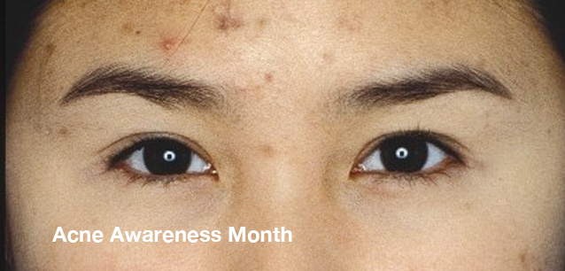 No image found Acne_Awareness_MonthE.png